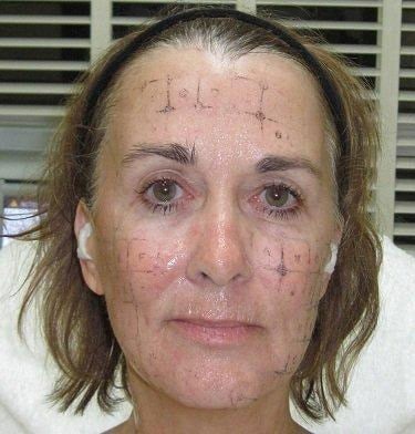 Halfway through Thermage<br /> Left side treated