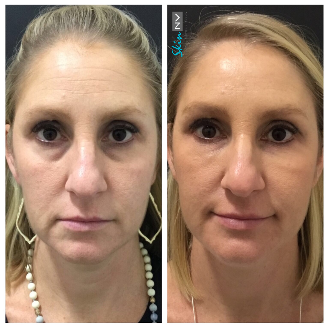 Before & After Gallery | Tampa Fillers, Botox, Lasers & More | Skin NV