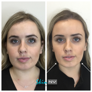 Two procedures for slimming down a round face – Madnani Facial Plastics