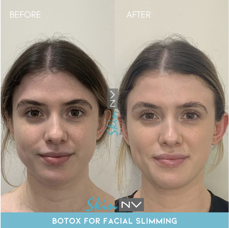 Make face slimmer by pressing 3 points