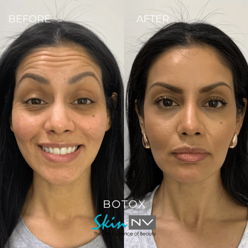 Tampa Botox Injections | Best Price on Botox in Tampa | Skin NV