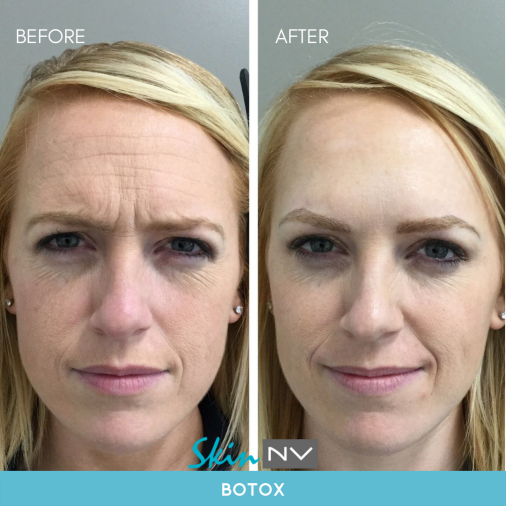 Before & After Gallery | Tampa Fillers, Botox, Lasers & More | Skin NV