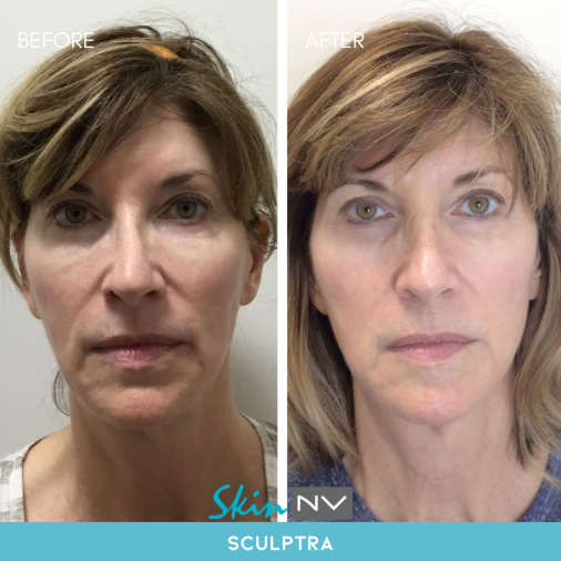 Before & After Gallery | Tampa Fillers, Botox, Lasers & More | Skin NV