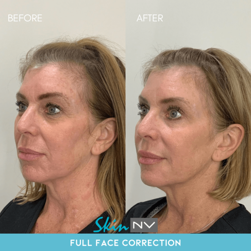 Before & After Gallery | Tampa Fillers, Botox, Lasers & More | Skin NV