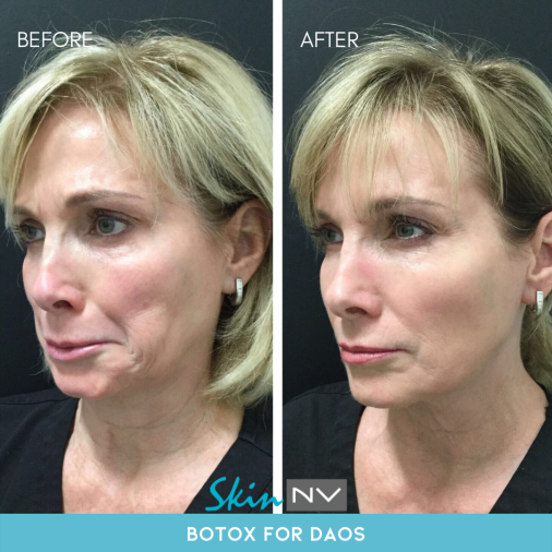 Before & After Gallery | Tampa Fillers, Botox, Lasers & More | Skin NV